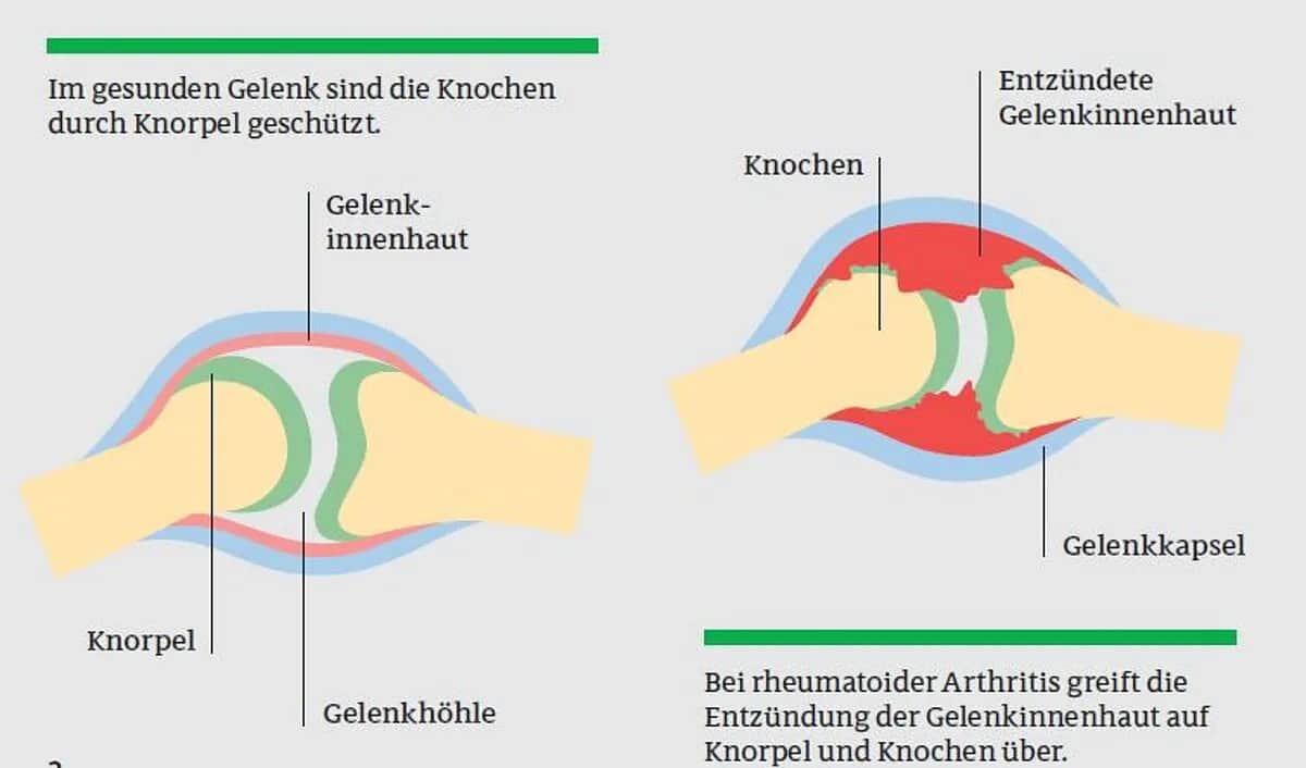 Die häufigsten Symptome der rheumatoiden Arthritis und ihre Folgen