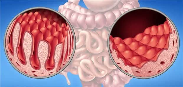 Zöliakie Diagnostik: So vermeiden Sie Fehldiagnosen und Schmerzen