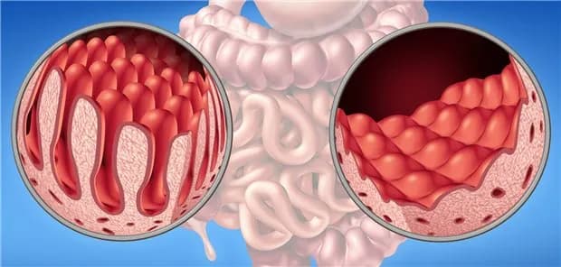 Zöliakie Diagnostik: So vermeiden Sie Fehldiagnosen und Schmerzen