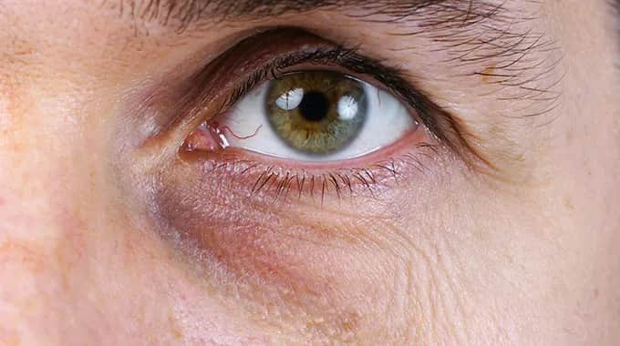 Eisenmangel symptome augen: Dunkle Augenringe und ihre Ursachen erkennen