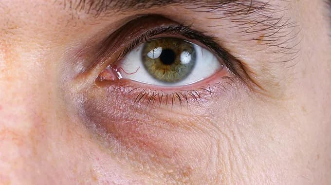 Eisenmangel symptome augen: Dunkle Augenringe und ihre Ursachen erkennen