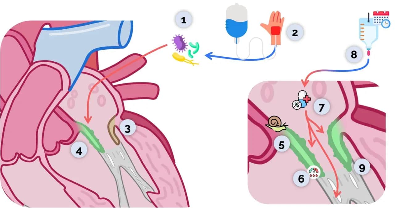 Endokarditis Symptome: Warnsignale, die Sie nicht ignorieren sollten