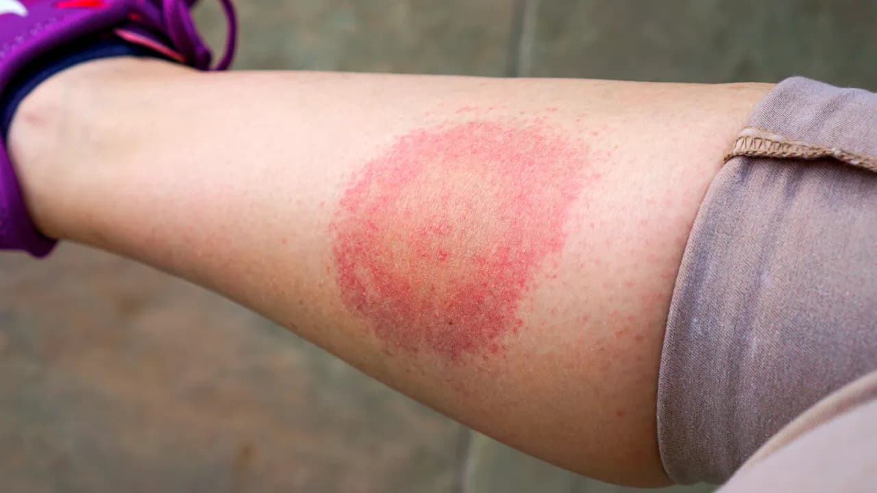 Borrelien Symptome beim Menschen: Warnzeichen, die Sie nicht ignorieren sollten