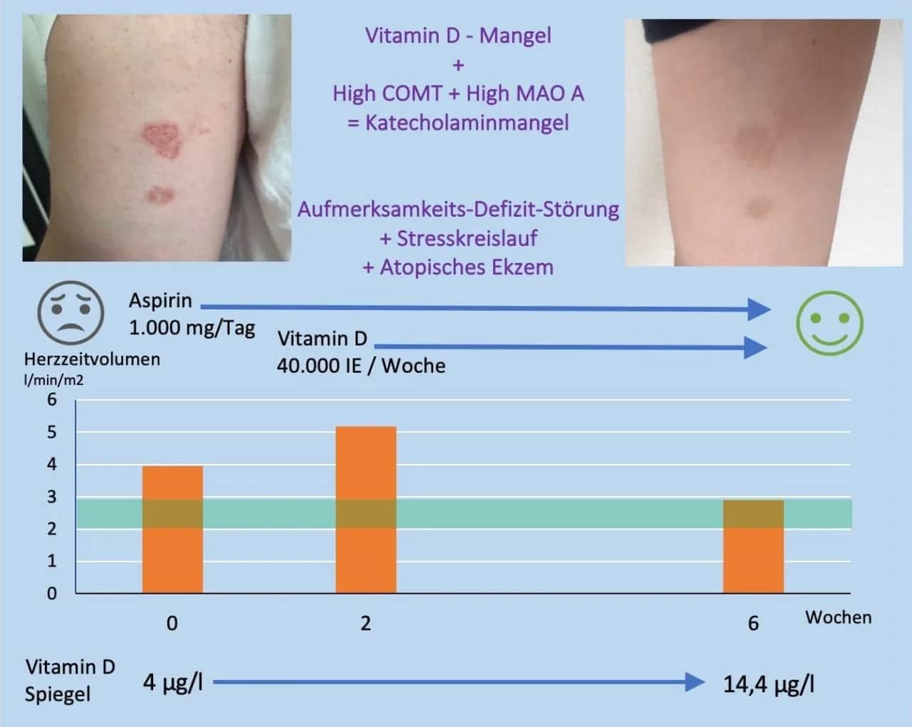Vitamin D Mangel Symptome bei Erwachsenen: Erfahrungsberichte und Anzeichen