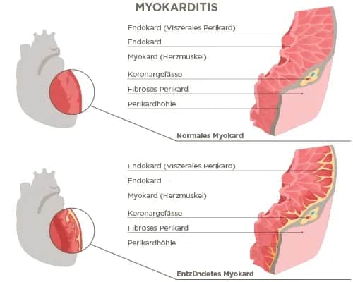Myokarditis Symptome: Warnsignale, die Sie nicht ignorieren sollten