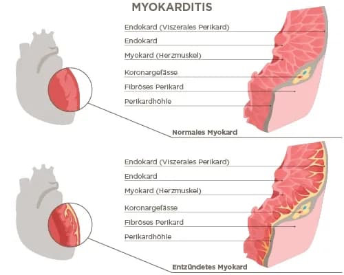 Myokarditis Symptome: Warnsignale, die Sie nicht ignorieren sollten