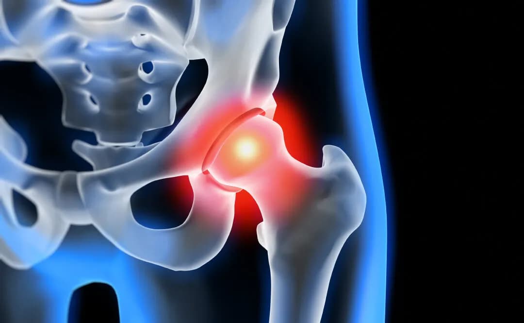 Coxarthrose Symptome: So erkennen Sie die schmerzhaften Anzeichen